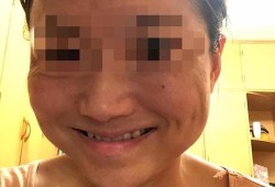 瘦脸针对胎儿有影响吗（瘦脸针对胎儿有影响吗?）