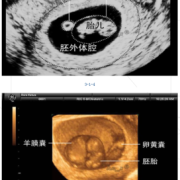 胎儿阴囊发育时间（胎儿阴囊发育时间表）