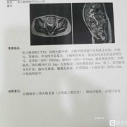 胎儿侧脑室增宽是什么原因导致的（胎儿侧脑室增宽是什么原因导致的怎么治疗）