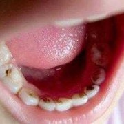孕期虫牙（孕期虫牙）