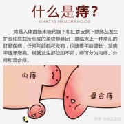 痔疮是如何产生的,孕期痔疮原因有哪些