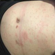 孕期肚皮长红点点（孕期肚皮长红点点对胎儿有影响吗）