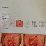 孕期宫颈息肉怎么办,孕期宫颈息肉一直有少量出血怎么办