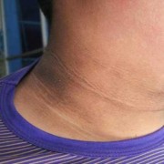 孕妇脖子变黑是怎么回事呢？正常的吗,孕期黑色素沉淀的原因有哪些