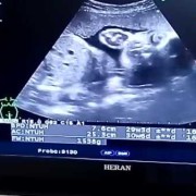 孕30周胎儿发育标准（我的宝宝30周B超显示腿偏短怎么办）