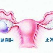 胎儿卵巢囊肿（胎儿卵巢囊肿是什么原因引起的）