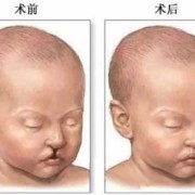 宝宝为什么会得裂唇，是遗传吗,胎儿裂唇是怎么形成的原因