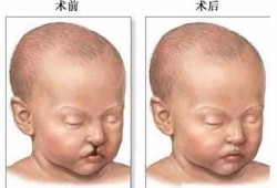 宝宝为什么会得裂唇，是遗传吗,胎儿裂唇是怎么形成的原因