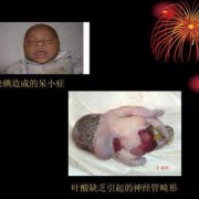 胎儿缺碘（胎儿缺碘）