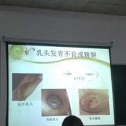 孕期乳头皲裂（孕期乳头皲裂图片和症状）