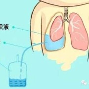 胎儿胸腔积液还能要吗（胎儿胸腔积液还能要吗）