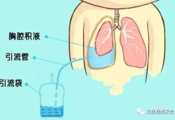 胎儿胸腔积液还能要吗（胎儿胸腔积液还能要吗）