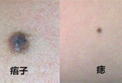 孕期长痣（孕期长痣是怎么回事啊）