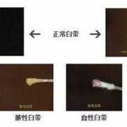 孕期白带颜色（孕期分泌物颜色对照表）