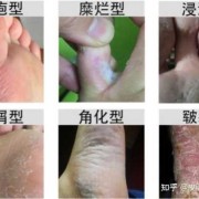 孕期有脚气（孕期的脚气该怎样治疗）