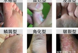 孕期有脚气（孕期的脚气该怎样治疗）