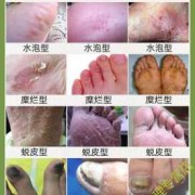 怀孕期间烂脚丫怎么办（怀孕期间烂脚丫怎么办啊）