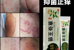 孕期股藓（孕期股藓可以擦什么）