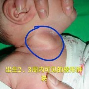胎儿颈部畸形（胎儿颈部畸形）