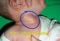 胎儿颈部畸形（胎儿颈部畸形）
