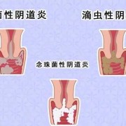 孕期阴道干燥