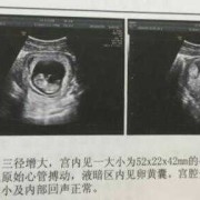 fl指胎儿的什么意思（fl指的是胎儿什么意思）