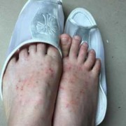 脚面痒,什么原因,孕期脚背痒是什么原因