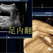 胎儿足内翻怎么回事,胎儿足周是多少周