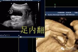 胎儿足内翻怎么回事,胎儿足周是多少周