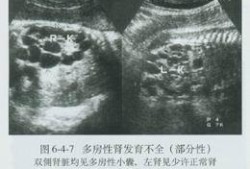 胎儿多囊肾是什么原因造成的（胎儿多囊肾会不会慢慢变好）