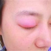 孕期眼肿（孕期眼肿）