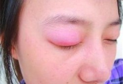 孕期眼肿（孕期眼肿）