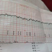 孕33周胎儿缺氧的表现是什么呢？谁知道呢,彩超能看出胎儿缺氧吗