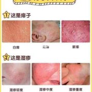 孕妇为什么生湿疹,怀孕期间长湿疹的原因有哪些