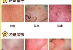 孕妇为什么生湿疹,怀孕期间长湿疹的原因有哪些