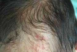 孕期胎毒有哪些症状（孕期胎毒有哪些症状图片）