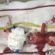 胎儿死图片（人为什么都要死呢？如果早晚都会死，那活着还有什么意义呢）