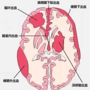 什么是第五第六脑室形成,胎儿第六脑室形成有什么危害