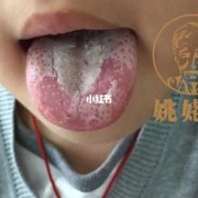 孕妇地图舌影响胎儿吗（孕妇地图舌对胎儿有影响吗）