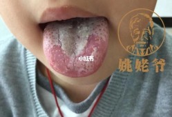 孕妇地图舌影响胎儿吗（孕妇地图舌对胎儿有影响吗）