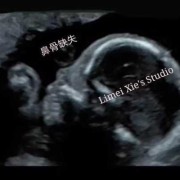 胎儿鼻骨图片（24周胎儿鼻骨长度标准）