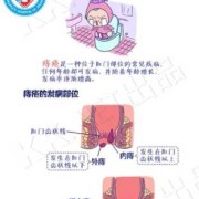 孕妇痔疮出来了要怎么办好,孕期内痔疮大便出血怎么办