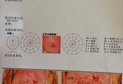 怀孕期间摘除宫颈息肉有影响吗,孕期宫颈息肉一直有少量出血怎么办