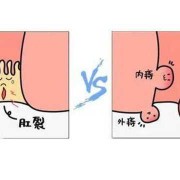 肛裂能怀孕吗,孕期肛裂疼痛如何缓解疼痛