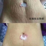 怀孕期间妊娠纹去除（孕妇肚子的妊娠纹怎么消除）