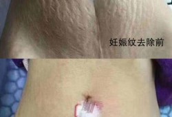 怀孕期间妊娠纹去除（孕妇肚子的妊娠纹怎么消除）