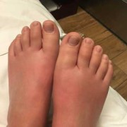 孕期脚僵硬（孕期脚僵硬）
