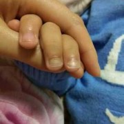 备孕期可以做指甲吗（脑级水手术后能要孩子吗）