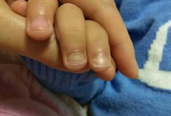 备孕期可以做指甲吗（脑级水手术后能要孩子吗）