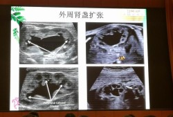 胎儿左肾集合系统分离（胎儿左肾集合系统分离0.5cm正常吗）